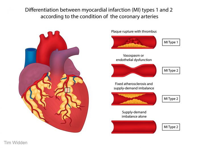 Things You Need to Know About Heart Attacks YupLife