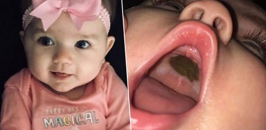 Black Mark in the Kid’s Mouth Embarrassed Mum